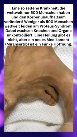Proteus-Syndrom: Eine seltene genetische Erkrankung 🧬