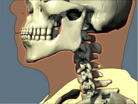 High Impact Rear-End Collision neck injury