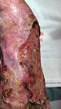 Venous stasis ulceration with pyoderma gangrenosum