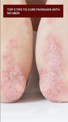 Psoriasis Diet Plan That Actually Works! Eat This, Not That! | Skin problem