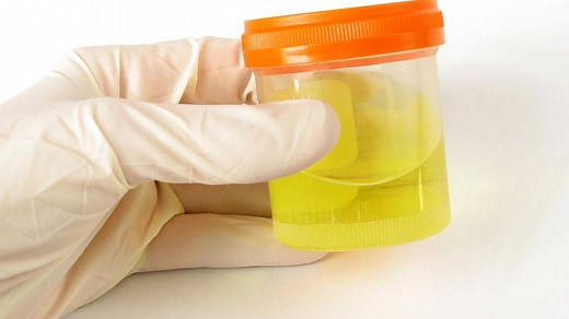 Protéinurie de Bence Jones