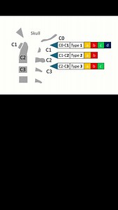 Learn more about CCI Type 2b in this CCI Type Series - Dr. Centeno breaks down the facts in under 2 minutes. Watch Now! #CCI #Craniocervicalinstability #DrCenteno | Centeno-Schultz Clinic | Facebook