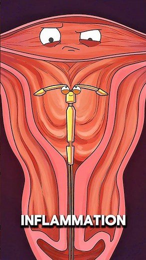 How an IUD Prevents Pregnancy Inside the Uterus 🩺🔬..!!#e2dhealth #animation #health #shorts