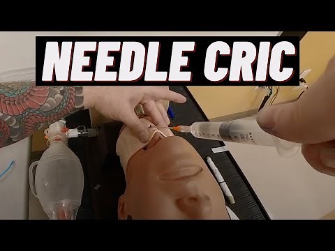 How to Perform Needle Cric?