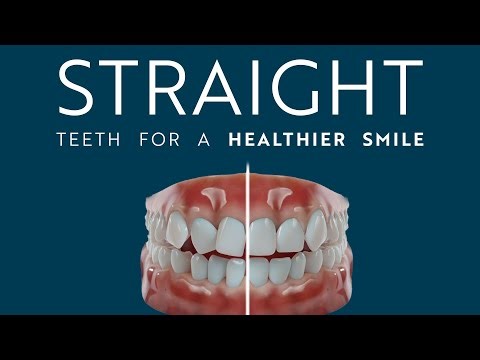 Straight Teeth for a Healthier Smile