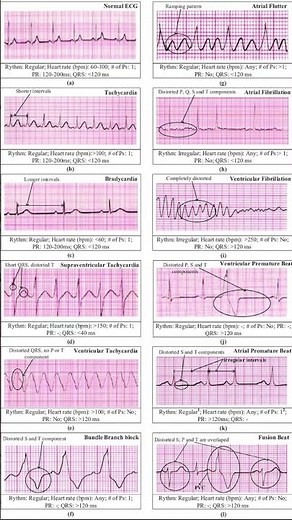 ECG summary #cardiology #ecg