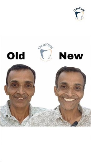 Crooked Teeth to Fixed Smile with Full Mouth Implants | Real Patient Story Navi Mumbai