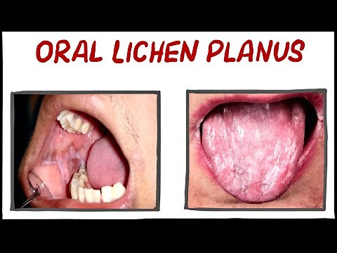 ORAL LICHEN PLANUS I CAUSE I SYMPTOMS I TREATMENT