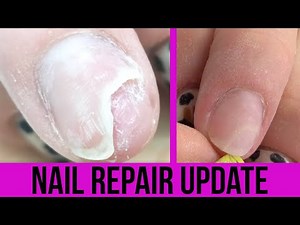 LOOK AT MY BROKEN NAIL - BROKEN NAIL UPDATE