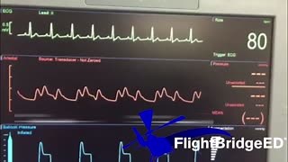 What is the IABP timing error here? Comment below and explain your answer! | FlightBridgeED