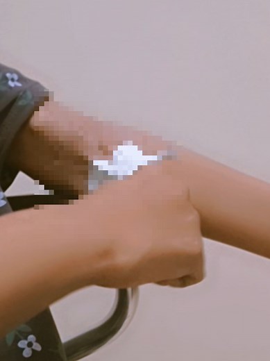 أسباب انتفاخ اليد بعد غسيل الكلى