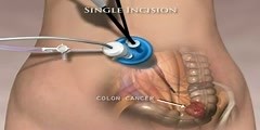 Single Incision Laparoscopic Colectomy...