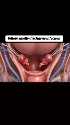 Uterine Infection: Yellow Smelly Discharge & Painful Process