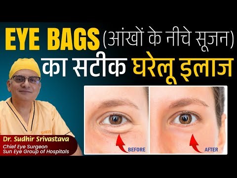 Eye puffiness, Eye bags treatment home remedies #suneyecafe #eyes #eyebags