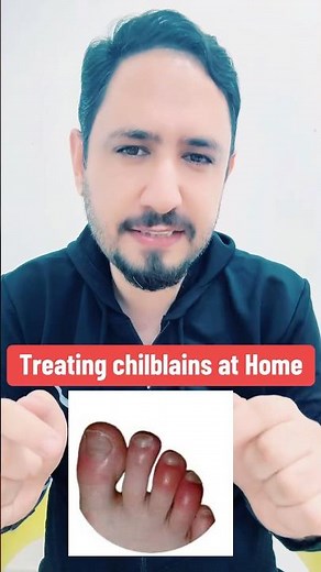 Treating chilblains at Home #chilblains #drirfanazeem #youtubeshorts #shorts #viralshorts #health