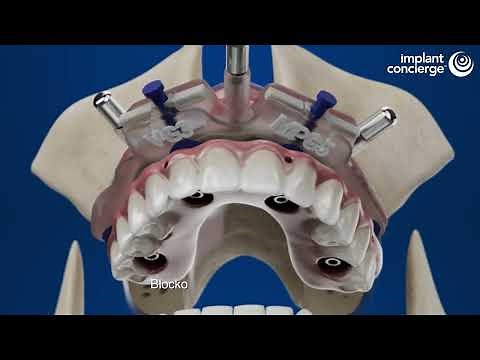 Implant Concierge: Bone Reduction Guide Technical Step-by-Step with Passive Fit Bridge