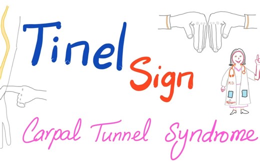 Tinel Sign | Carpal Tunnel Syndrome