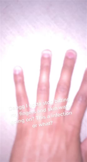 Skin Peeling Finger Infection: What's Happening?