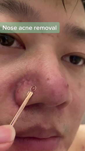 Really hurt 😢 Deleted last vid for too short,pls view this one ✌️#acne #pimple #acneremoval #zit #acnefighter #acneskin #skins #skincare