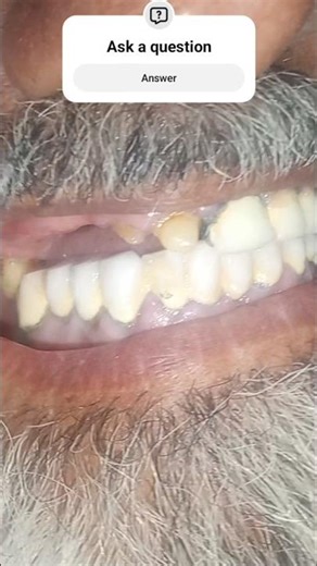 Fixed Teeth Treatment| Fracture in teeth| Zirconia crowns vs PFM Crown| Before and After Treatment