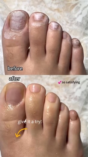 Secret Nails on Instagram: "2 in 1 nail strengthen ceramic pen infused with oil that clean your cuticle, nail surface and remove dead skin easily, strengthen your natural nails and bring the shine of your natural nails back You can get it from our website please feel free to visit our website and click on the product Nail strengthening and renewal pen. Here’s the website link: www.secret-nails.com"