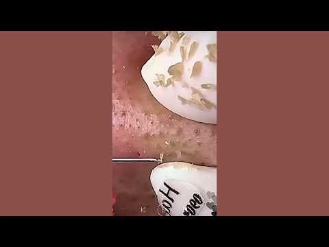 Skincare | Blackheads Removal #776 #tweezers skincare #blackheads blackheads