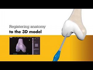 Mako Total Knee animation