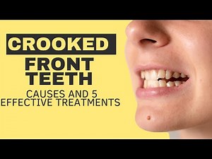 Crooked Front Teeth: Causes and 5 Effective Treatments