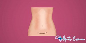 ➤ Plan de cuidados de enfermería para el parto por cesárea y su gestión 【2024】