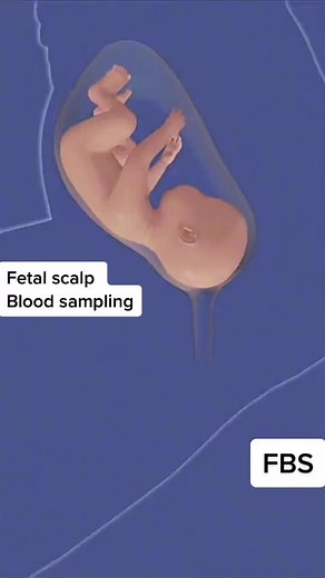 Fetal Blood Sampling Procedure During Pregnancy