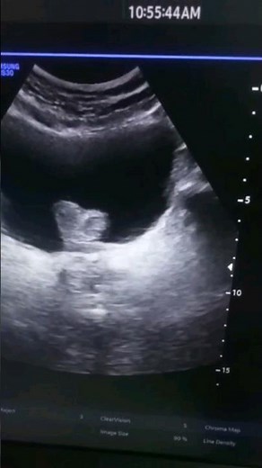 Median lobe enlarge/Intravesical protrusion/ Ultrasound short video