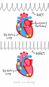 Comparing Heart's Conduction in AVRT & AVNRT (Supraventricular Tachycardia) | Daily Cardiology