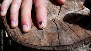 Hammer and human finger with dark bruised nail. Finger injury. Black hematoma on nails after hammering. Dangerous job.