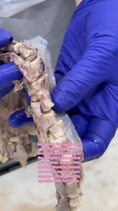 #Pathology #Surgicalpathology #Neuropathology