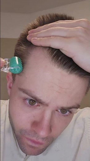 How I use Minoxidil and the Derma Roller for Hair RESTORATION