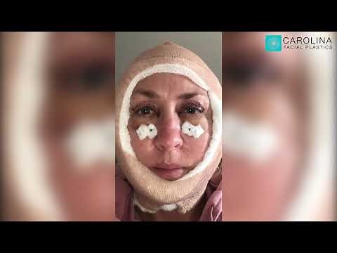 Upper and Lower Blepharoplasty and Mini Facelift Vlog