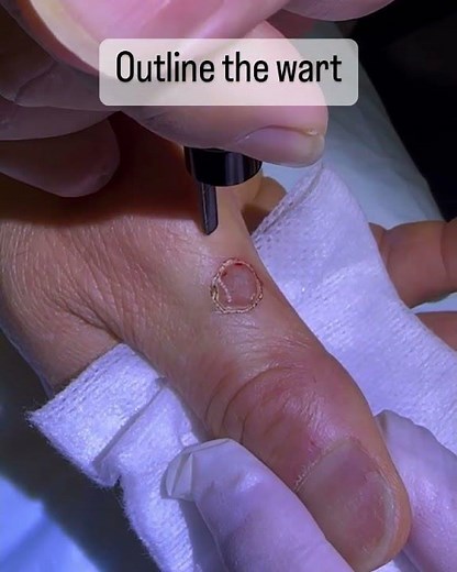 Laser finger toe wart removal Sydney