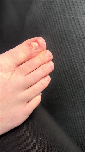 Toe Nail Reconstruction Services in Liverpool 🦶🏻