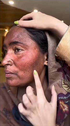 DIY Homemade Pigmentation Melasma UnevenSkin Darkspot Natural Facepack Remedy