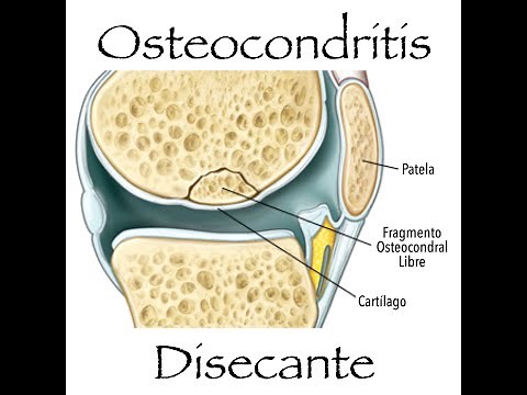 Osteocondritis Disecante que es? que puedo hacer en casa?