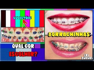 WHICH COLOR OF ORTHODONTIC BRACES RUBBER SHOULD I CHOOSE? (SUGGESTIONS)