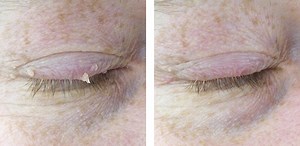 Skin Tag Removal Video - CO2RE Laser - Skin Surgery Clinic Leeds