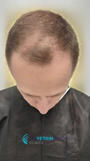 Achieving your dream hair is now possible! 💫 Dr. Yetkin Bayer, located in the heart of Istanbul, offers you the best hair transplant services with a professional team and state-of-the-art techniques. 🌟 •Natural-looking hair •Painless and comfortable process •Personalized treatment plans You can also entrust yourself to Dr. Yetkin Bayer’s expert team. Contact us for consultation and special offers regarding hair transplant surgery. 📞0 545 435 62 77 🌐info@yetkinbayer.com 📍Kuruçeşme, Ahmet Adn