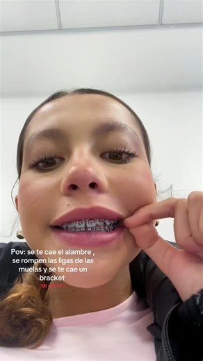 Colores de Brackets: Cuidados y Consecuencias