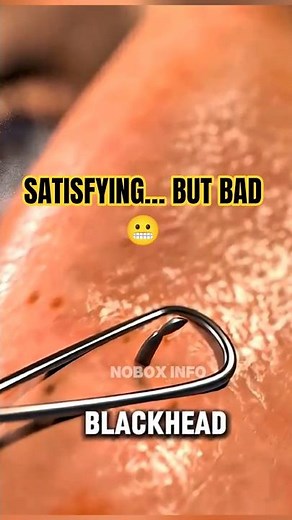 How Squeezing Blackheads Works 🤔 What Really Happens During Extraction 😲 #shorts #health #blackheads