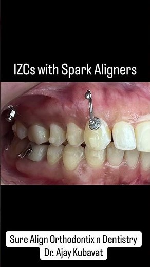 The Physics of Perfect Distalization: IZC + Spark Aligners + Power Arm Biomechanics Explained