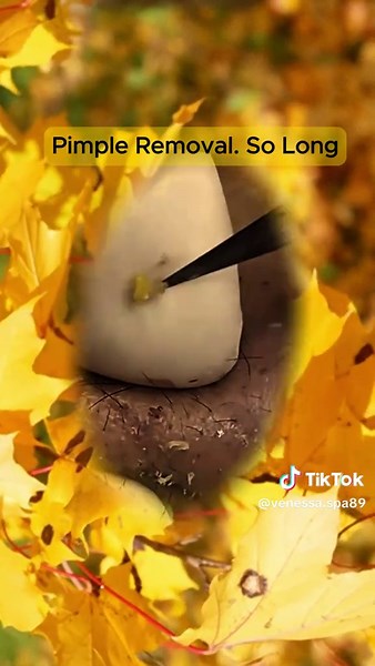 Satisfying Pimple and Blackhead Extraction Compilation