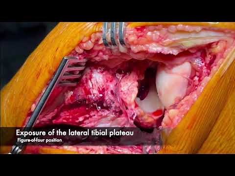 The Intact Meniscal “Bucket Handle” Technique to Expose Complex Lateral Tibial Plateau Fractures