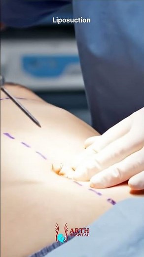 How Fat is Removed in Liposuction | 3D Medical Animation Explained #shorts