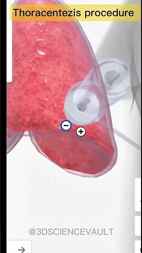 Thoracentesis procedure in 3D | Pleural Fluid Removal Step by Step